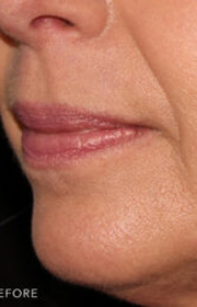 patient 2853 before